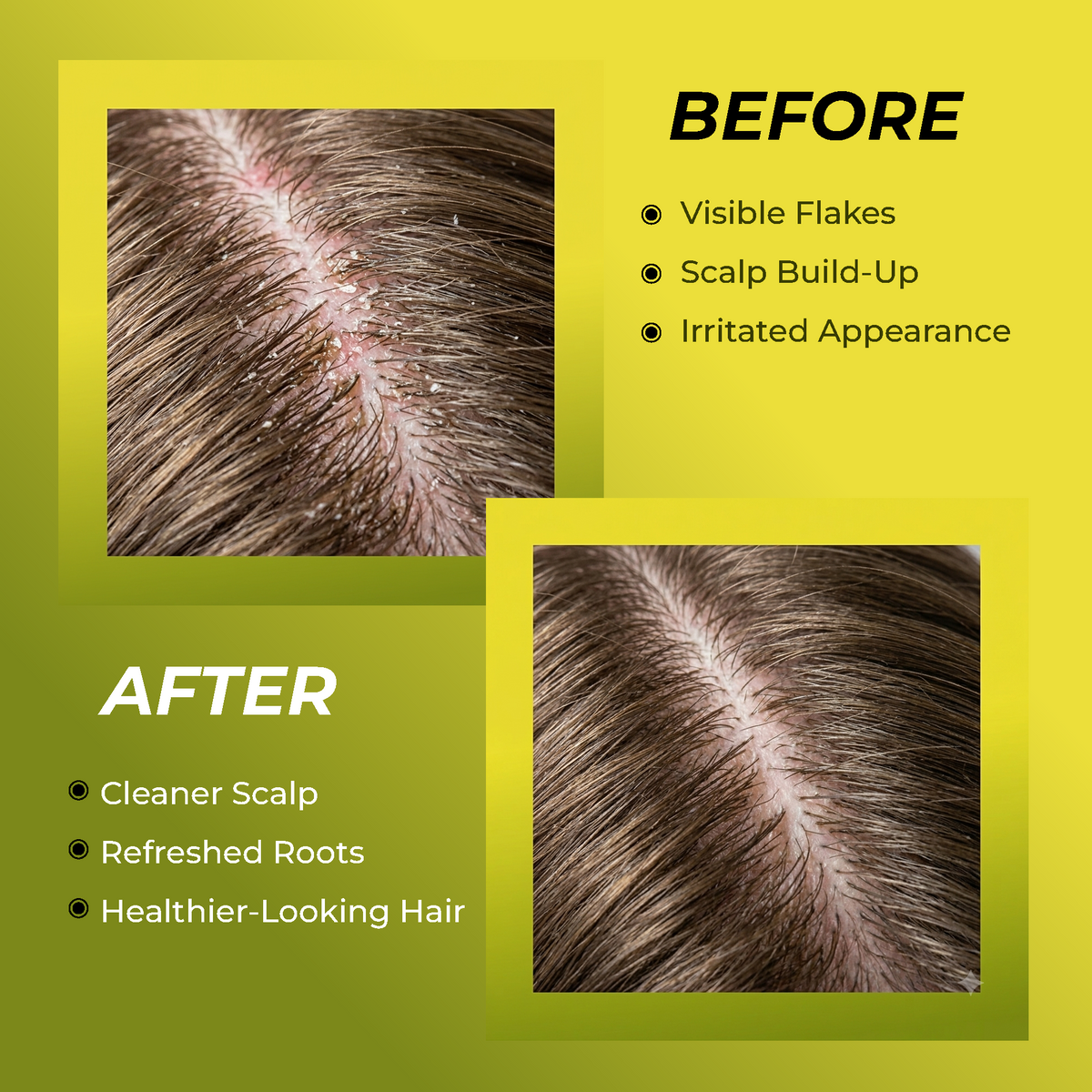 Folliculitis Shampoo