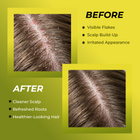 Folliculitis Shampoo