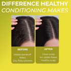 Folliculitis  Conditioner