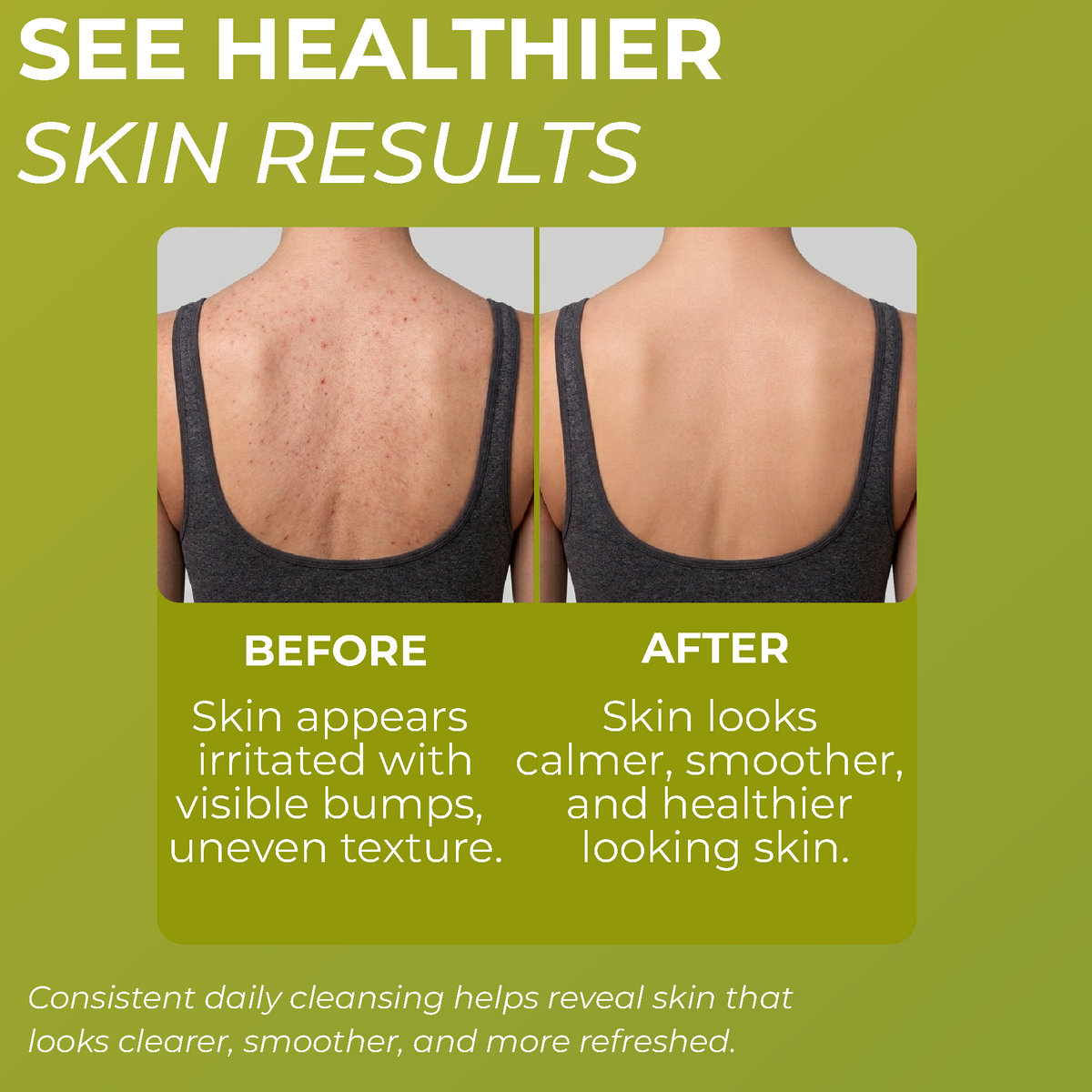Folliculitis body wash foam