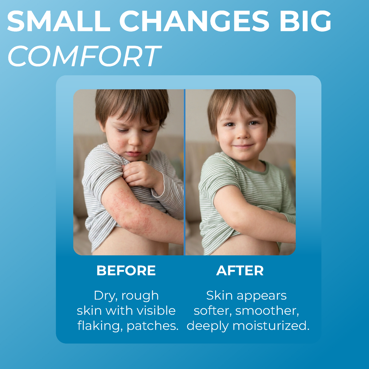 Eczema treatment for kids