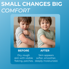 Eczema treatment for kids