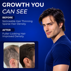 Minoxidil for Men Foams