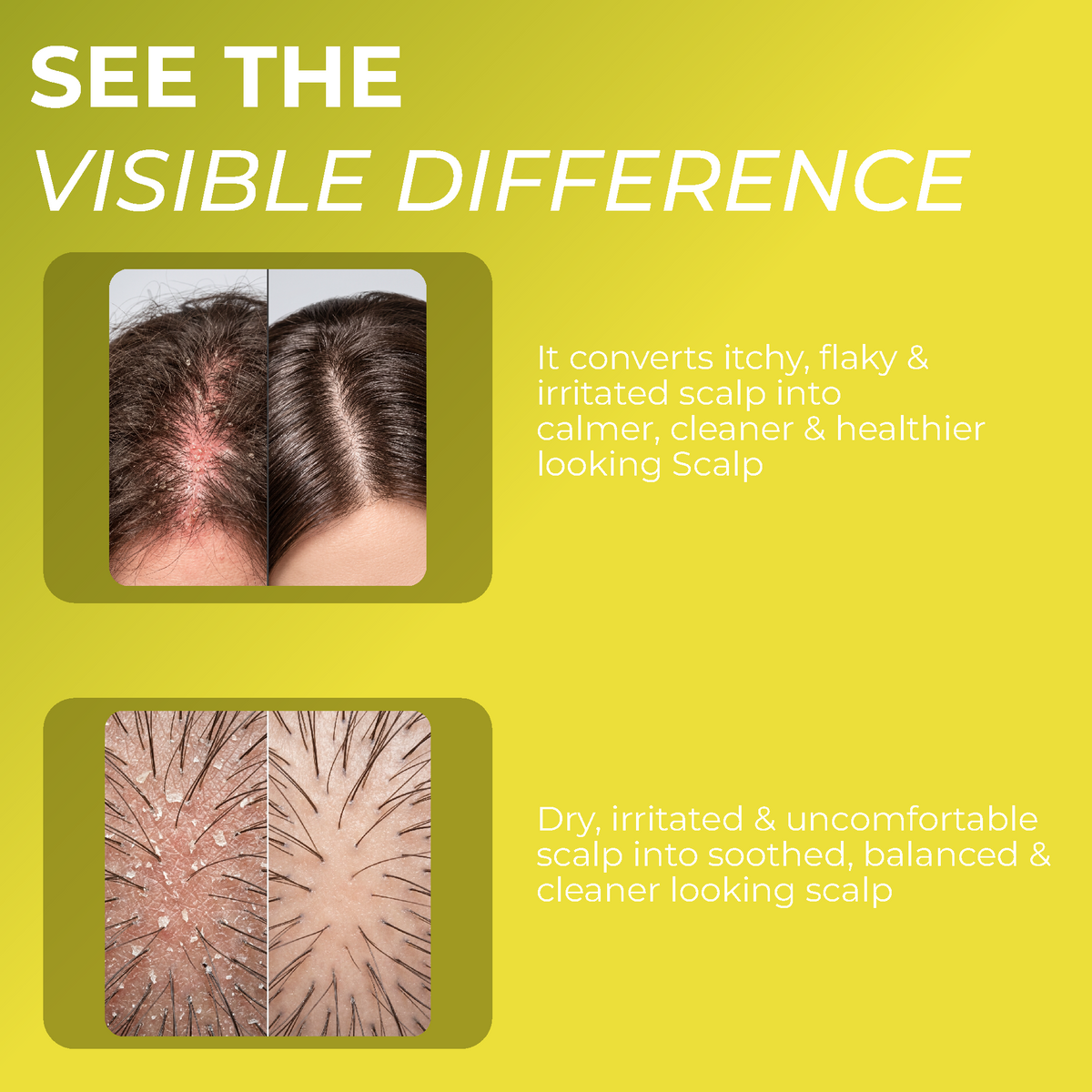 Folliculitis Scalp Spray