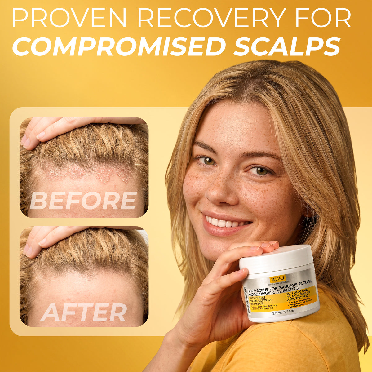 Psoriasis Scalp scrub