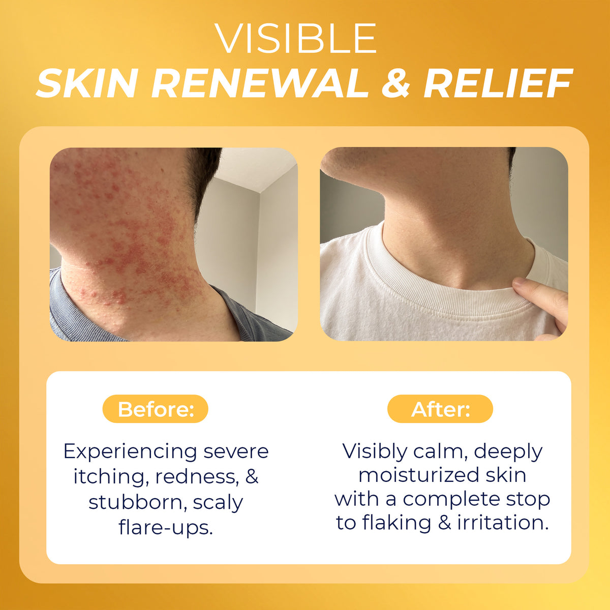 Psoriasis Big Lotion