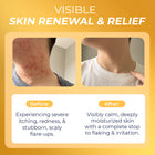 Psoriasis Big Lotion