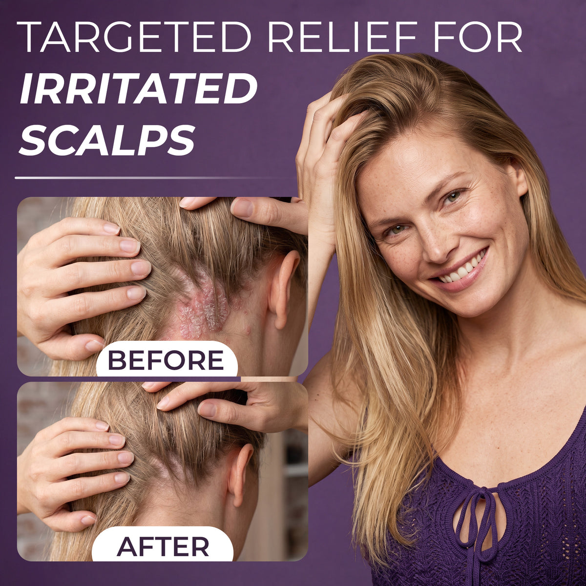 Neoketramin Scalp Spray
