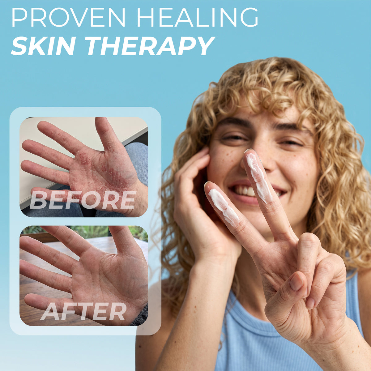 Eczema cream