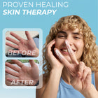 Eczema cream