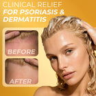 Psoriasis Shampoo
