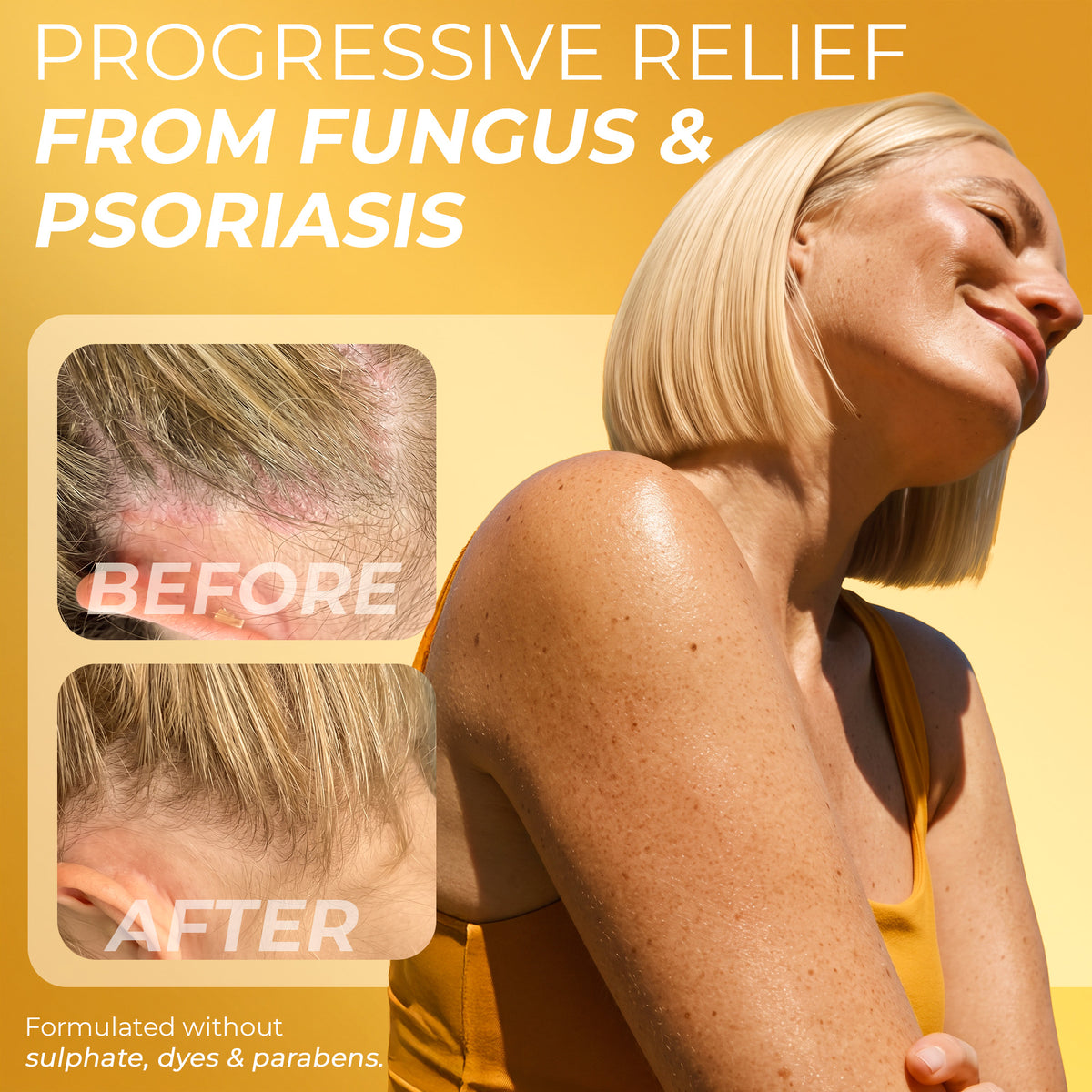 Psoriasis Scalp Spray