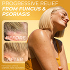 Psoriasis Scalp Spray