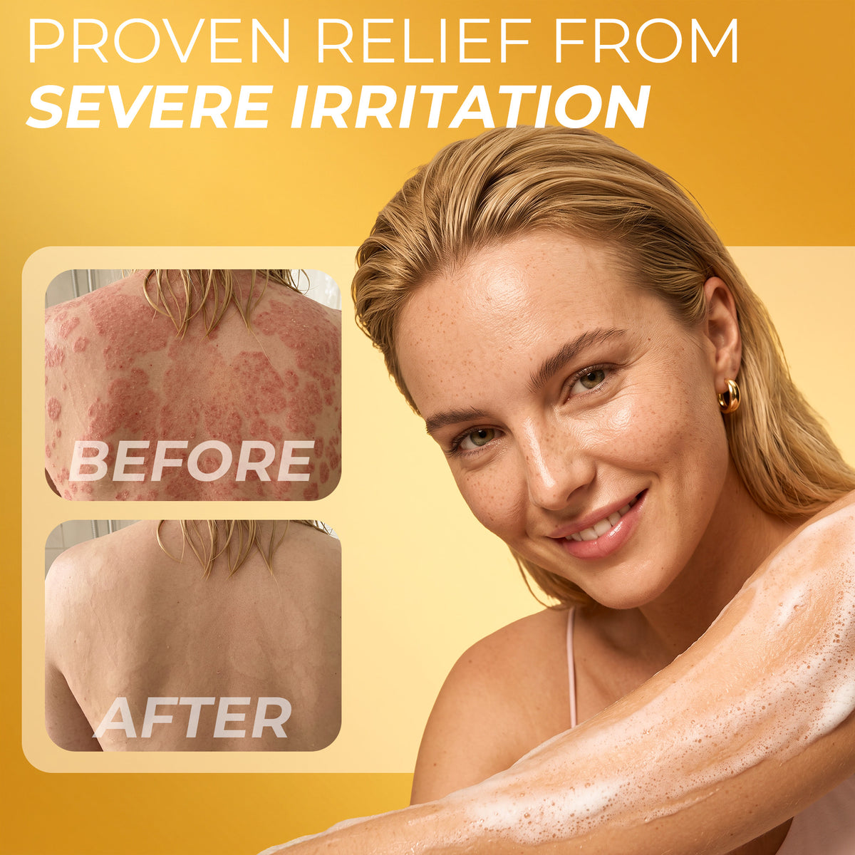 Psoriasis body wash foam