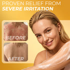 Psoriasis body wash foam